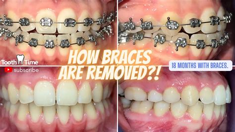 how to remove metal brackets from teeth|best way to remove braces.